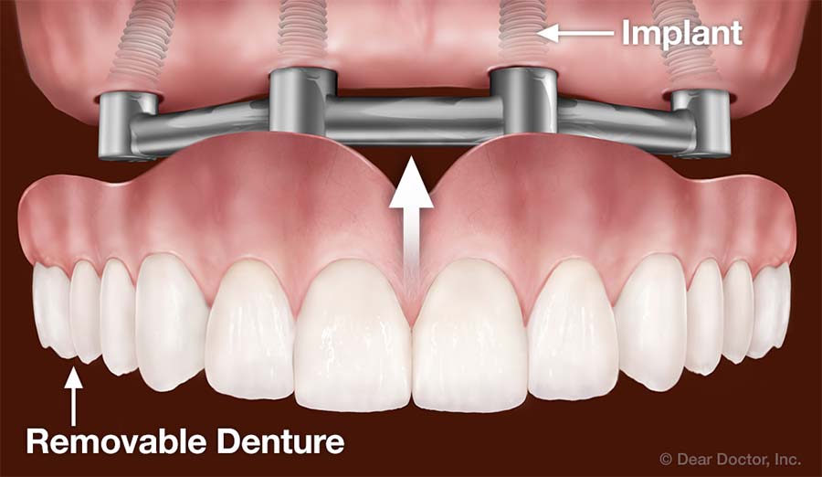 Illustration of implant-supported dentures